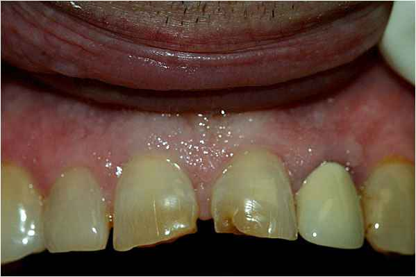 Dental Crowns Before